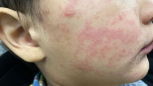 2026 Virginia Measles Cases an Update